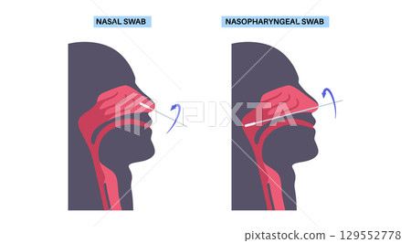 Nasopharyngeal and nasal swab 129552778