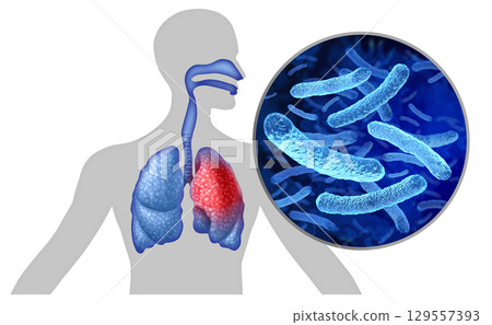 legionaires disease Symptoms 129557393