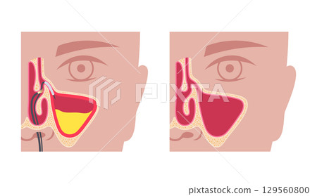 Balloon sinuplasty poster Balloon sinuplasty poster 129560800