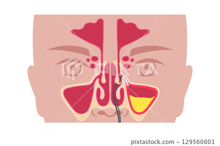 Balloon sinuplasty poster Balloon sinuplasty poster 129560801