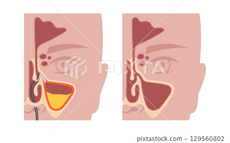 Balloon sinuplasty poster Balloon sinuplasty poster 129560802