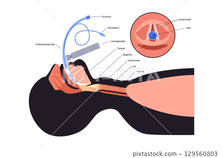 Intubation medical procedure Intubation medical procedure 129560803