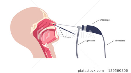 Nasal endoscopy poster 129560806