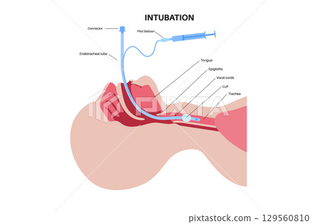 Intubation medical procedure 129560810
