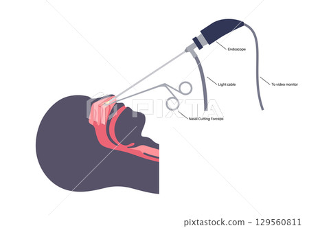 Nasal endoscopy poster Nasal endoscopy poster 129560811