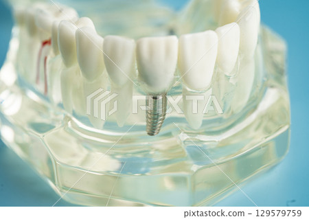 Dental implant, artificial tooth roots into jaw, root canal of dental treatment, gum disease, teeth model for dentist studying about dentistry. Dental implant, artificial tooth roots into jaw, root canal of dental treatment, gum disease, teeth model for dentist studying about dentistry. 129579759