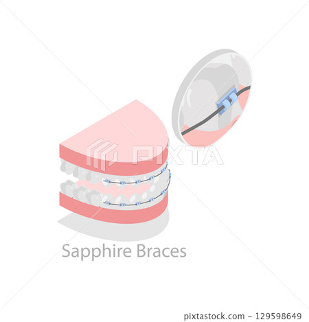 3D Isometric Flat Vector Illustration of Dental Teeth Braces Types, Orthodontic Options for Teeth Straightening. Item 5 129598649