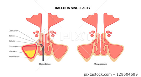Balloon sinuplasty poster 129604699