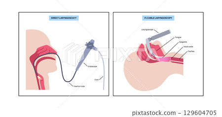 Laryngoscopy medical procedure 129604705