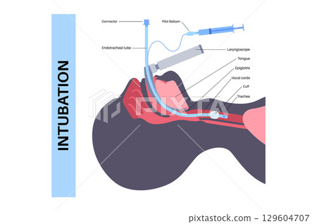 Intubation medical procedure Intubation medical procedure 129604707