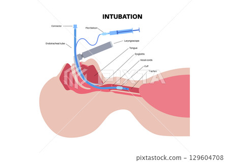 Intubation medical procedure Intubation medical procedure 129604708
