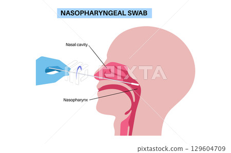 Nasopharyngeal swab procedure 129604709