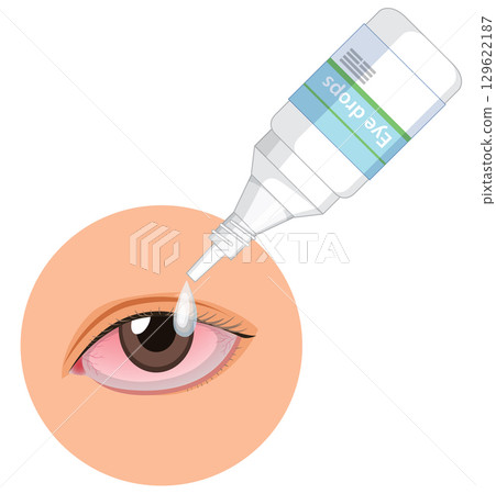 Applying Eye Drops to Red Irritated Eye Illustration 129622187