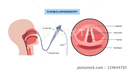 Laryngoscopy medical procedure Laryngoscopy medical procedure 129644785