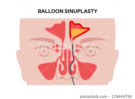 Balloon sinuplasty poster Balloon sinuplasty poster 129644786