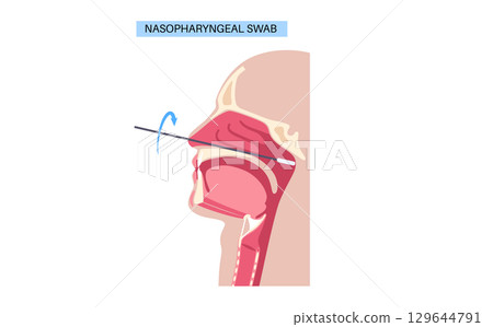 Nasopharyngeal swab procedure 129644791