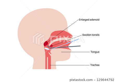 Adenoidectomy medical procedure Adenoidectomy medical procedure 129644792