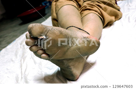 Close-Up of Cracked Heels and Bare Feet with Toe Ring and Anklet 129647603