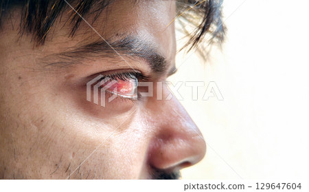 Close-Up of Male Eye with Conjunctivitis or Eye Infection 129647604