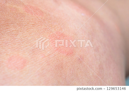Young asian man has allergic skin rash on his legs from itchy dry skin eczema dermatitis insect bites Young asian man has allergic skin rash on his legs from itchy dry skin eczema dermatitis insect bites 129653146