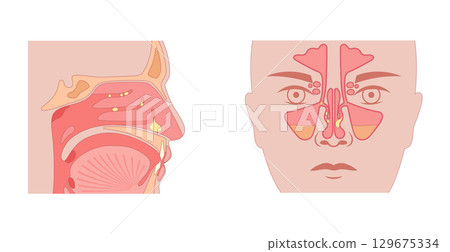 Nasal polyps poster Nasal polyps poster 129675334