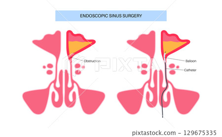 Balloon sinuplasty poster 129675335
