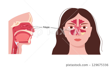 Nasal polyps poster Nasal polyps poster 129675336