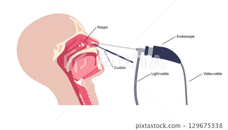 Nasal endoscopy poster Nasal endoscopy poster 129675338