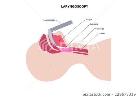 Laryngoscopy medical procedure Laryngoscopy medical procedure 129675339