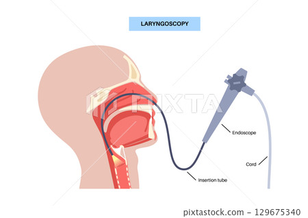 Laryngoscopy medical procedure Laryngoscopy medical procedure 129675340