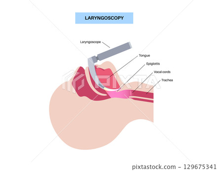 Laryngoscopy medical procedure Laryngoscopy medical procedure 129675341