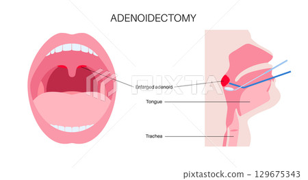 Adenoidectomy medical procedure 129675343