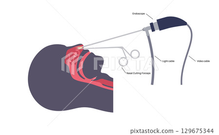 Nasal endoscopy poster Nasal endoscopy poster 129675344
