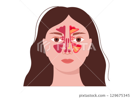 Nasal polyps poster 129675345