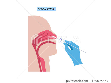 Nasal swab procedure Nasal swab procedure 129675347