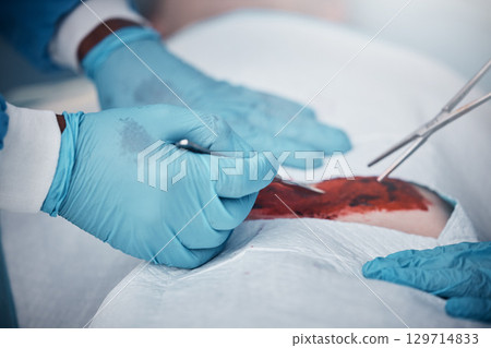Hands, blood and operation with a team of doctors at work during surgery with equipment or a tool in a hospital. Doctor, nurse and collaboration with a medicine professional group saving a life 129714833