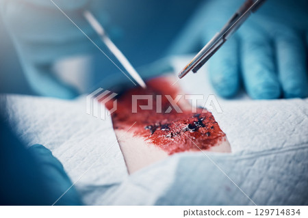 Doctors, nurses or surgery hands on cut patient in hospital emergency room for stomach ulcer, heart attack or burst appendix. Blood, healthcare workers or surgical operation and steel metal equipment 129714834