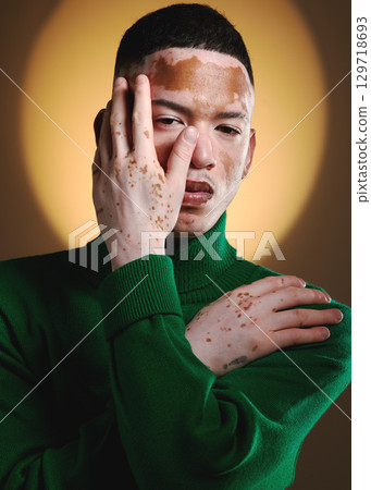 Vitiligo, man face and fashion model portrait for luxury beauty, style and designer brand. Skin pigmentation, hand pose and model posing for expensive clothing with creative and stylish light 129718693