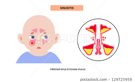 Sinusitis medical poster Sinusitis medical poster 129725959