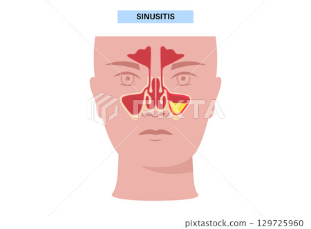 Sinusitis medical poster 129725960