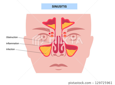 Sinusitis medical poster 129725961
