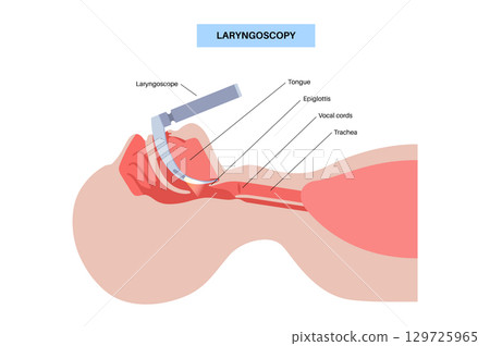 Laryngoscopy medical procedure Laryngoscopy medical procedure 129725965