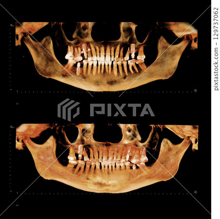 Computed tomography of adult female patient with dental root and implant treatments. Dental x-ray of an adult patient showing teeth, jaws and a dental implant. Modern digital tomography for dentistry 129737062