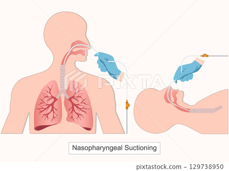 Nasopharyngeal suctioning is a medical procedure. 129738950