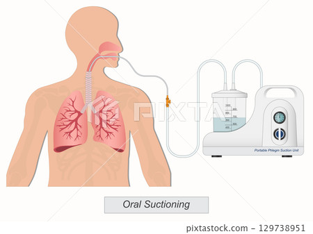 Oral suction is suction that is applied to removing mucous secretions. 129738951