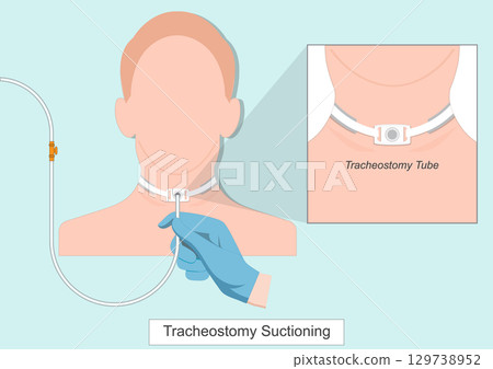 Suctioning the tracheostomy tube is performed to remove secretions. 129738952