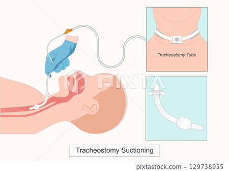 Tracheal Suctioning is a means of clearing the airway of secretions or mucus 129738955