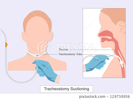 Tracheostomy suctioning removes mucus and secretions cannot clear with coughing. 129738956