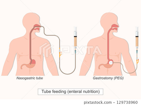 Tube feeding (enteral nutrition). Tube feeding (enteral nutrition). 129738960