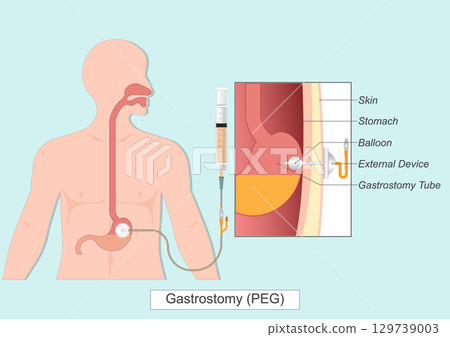 Gastrostomy or PEG Tube. Gastrostomy or PEG Tube. 129739003